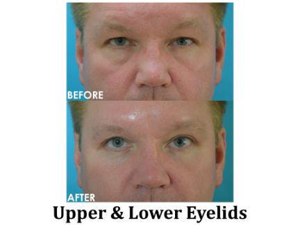 Blepharoplasty Before & After Image