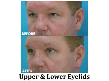 Blepharoplasty Before & After Image