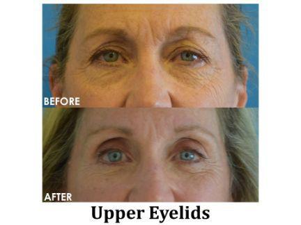 Blepharoplasty Before & After Image
