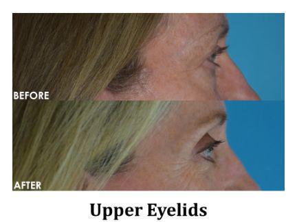 Blepharoplasty Before & After Image