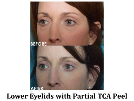 Blepharoplasty Before & After Image