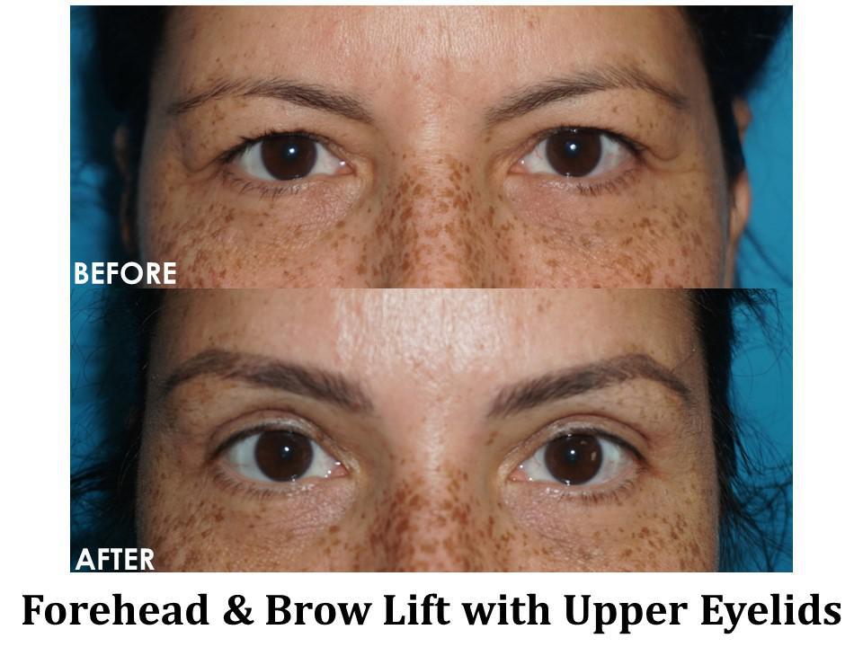 Blepharoplasty Before & After Image