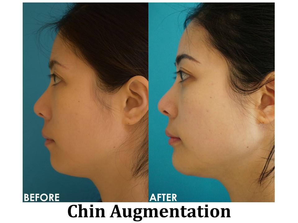 Chin Augmentation Before & After Image