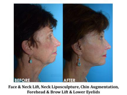 Chin Augmentation Before & After Image