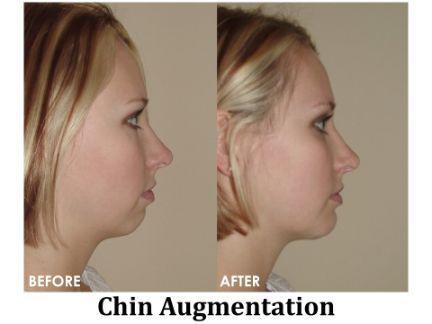 Chin Augmentation Before & After Image