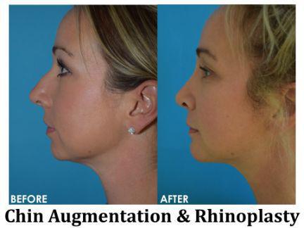Chin Augmentation Before & After Image