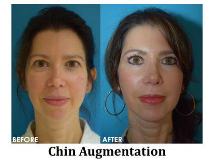 Chin Augmentation Before & After Image