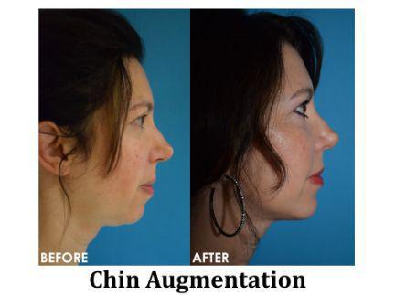Chin Augmentation Before & After Image