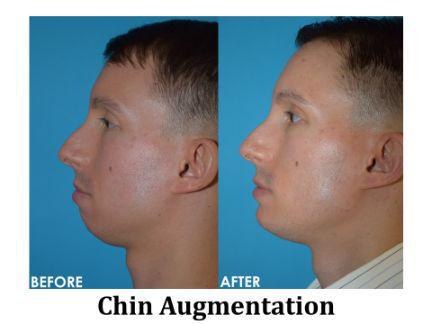 Chin Augmentation Before & After Image