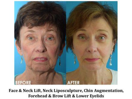Facelift & Neck Lift Before & After Image