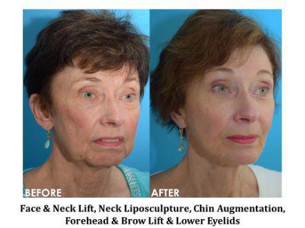 Facelift & Neck Lift Before & After Image