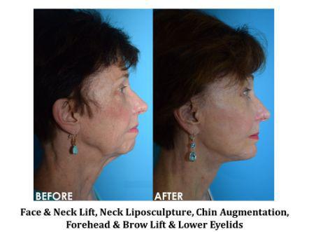 Facelift & Neck Lift Before & After Image