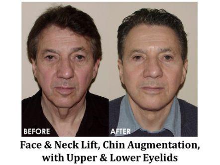 Facelift & Neck Lift Before & After Image