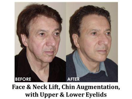 Facelift & Neck Lift Before & After Image
