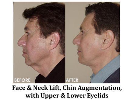 Facelift & Neck Lift Before & After Image