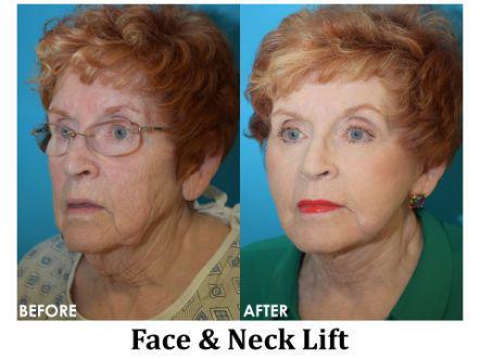 Facelift & Neck Lift Before & After Image