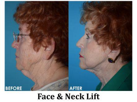 Facelift & Neck Lift Before & After Image