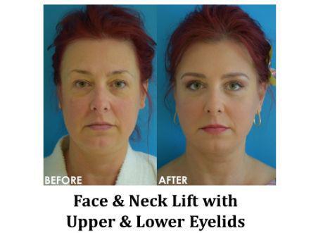 Facelift & Neck Lift Before & After Image
