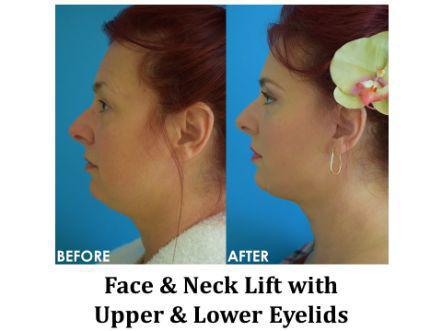 Facelift & Neck Lift Before & After Image