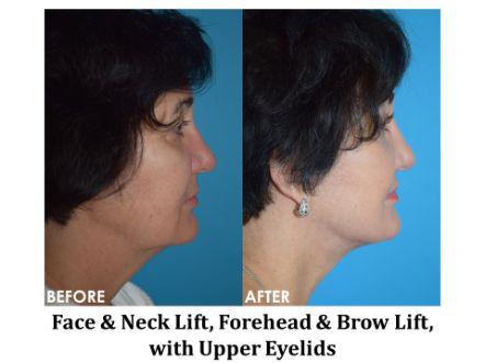 Facelift & Neck Lift Before & After Image