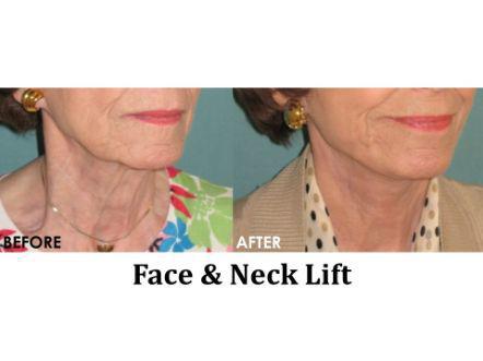 Facelift & Neck Lift Before & After Image