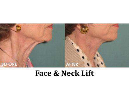 Facelift & Neck Lift Before & After Image