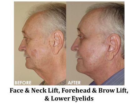 Facelift & Neck Lift Before & After Image