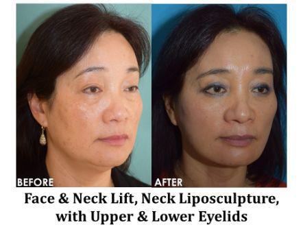 Facelift & Neck Lift Before & After Image