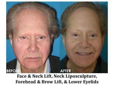 Facelift & Neck Lift Before & After Image
