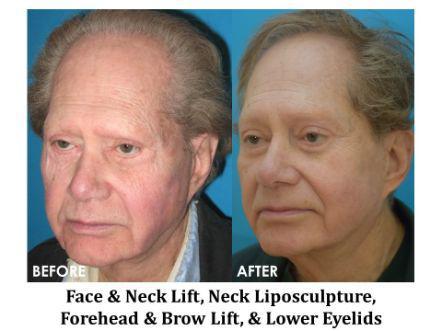 Facelift & Neck Lift Before & After Image