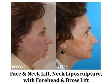 Facelift & Neck Lift Before & After Image