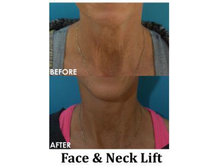 Facelift & Neck Lift Before & After Image