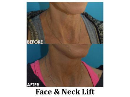 Facelift & Neck Lift Before & After Image