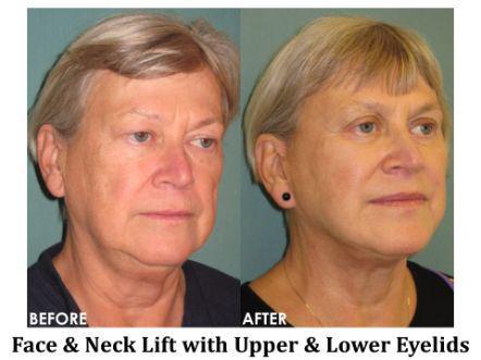 Facelift & Neck Lift Before & After Image
