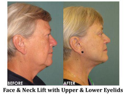 Facelift & Neck Lift Before & After Image