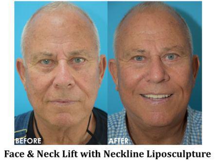 Facelift & Neck Lift Before & After Image