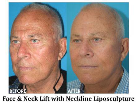 Facelift & Neck Lift Before & After Image