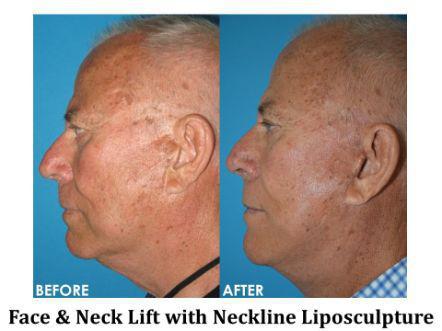 Facelift & Neck Lift Before & After Image