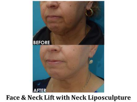 Facelift & Neck Lift Before & After Image
