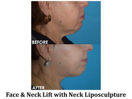 Facelift & Neck Lift Before & After Image