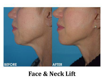 Facelift & Neck Lift Before & After Image
