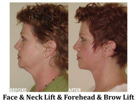 Facelift & Neck Lift Before & After Image