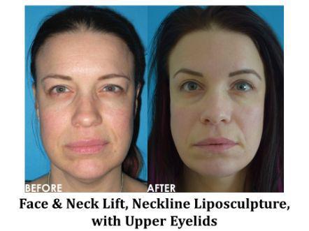 Facelift & Neck Lift Before & After Image