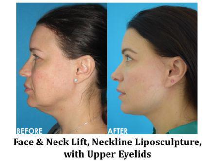 Facelift & Neck Lift Before & After Image