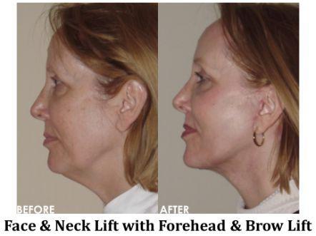 Facelift & Neck Lift Before & After Image