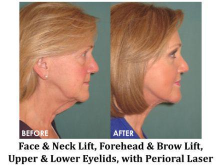 Facelift & Neck Lift Before & After Image