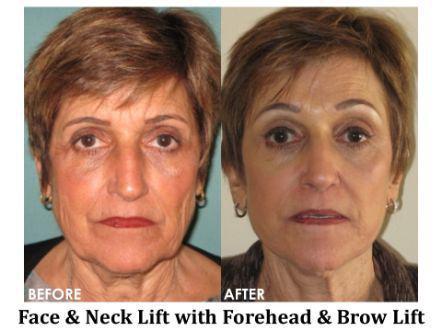 Facelift & Neck Lift Before & After Image