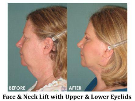 Facelift & Neck Lift Before & After Image
