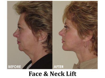 Facelift & Neck Lift Before & After Image