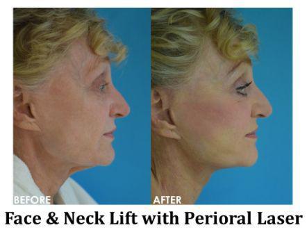 Facelift & Neck Lift Before & After Image